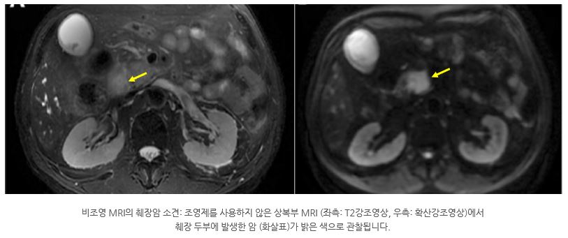 췌장암 조기진단에는 복부MRI(MRI) 검사