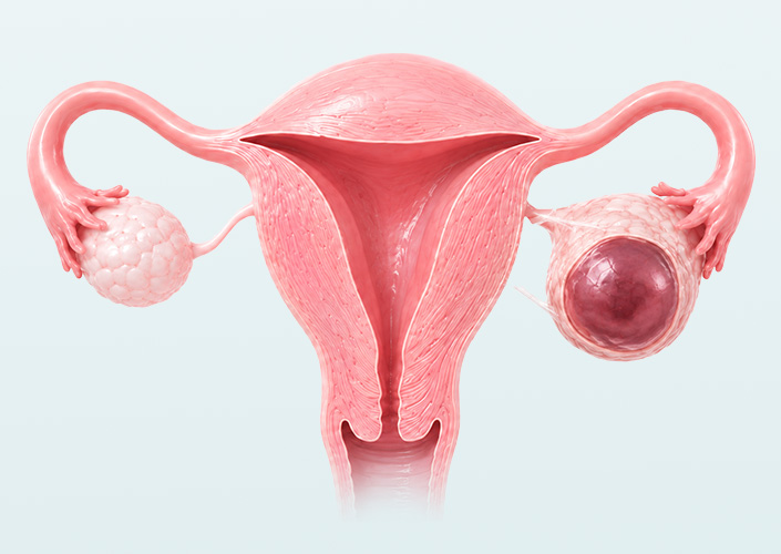 Ovarian disease02