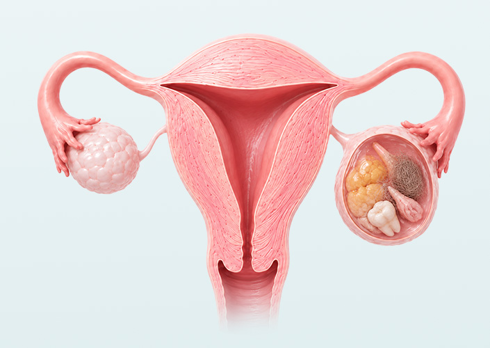 Ovarian disease03