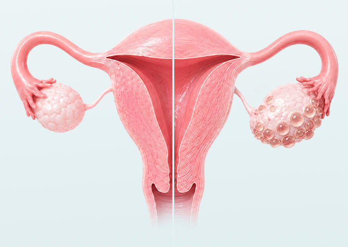 Ovarian disease04