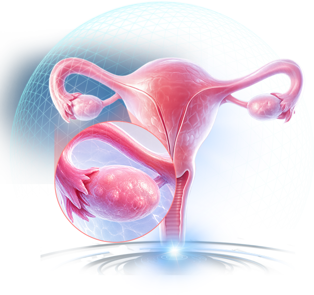 Ovarian preservation 1
