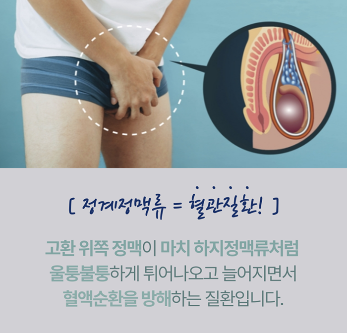 정계정맥류 증상과 치료 민트병원 정맥류센터2 1