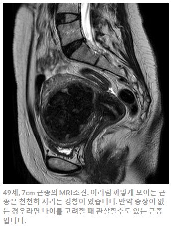 자궁근종하이푸_칼럼_김영선원장2.JPG