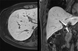 간 MRI 검사 시 프리모비스트 조영제가 중요한 이유